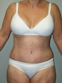 Belt Lipectomy