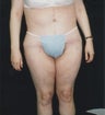 Abdominoplasty