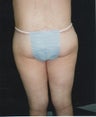 Abdominoplasty