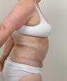Panniculectomy