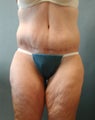 Lower Body Lift