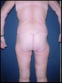 Body Lift after Massive Weight Loss