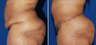 Lower Body Lift