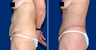 Lower Body Lift
