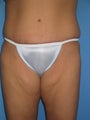 Torsoplasty