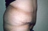 Body Contouring
