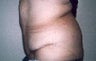 Body Contouring