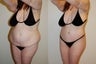Body Lift