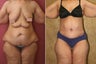 Body Lift after massive weight loss