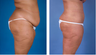 Central body lift with liposuction age 32