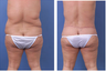 Central body lift with liposuction of thighs and back, age 42