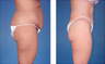 Central body lift with liposuction age 38