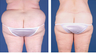 Central body lift with liposuction age 53