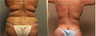 Lower Body Lift (Belt Lipectomy)