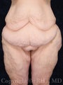Lower Body Lift (circumferential beltlift)