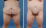 Bilateral Lower Body Lift and Liposuction