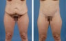 Lower Body Lift and Liposuction of Lateral Thighs