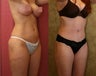 body lift