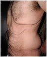 Body Lift and Male Breast Reduction