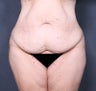 Body Lift