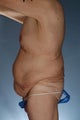 Body Lift
