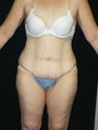 Body Lift and Breast Implans
