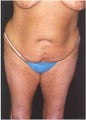 Body Lift