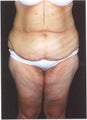 Body Lift  and Inner Thigh Lift