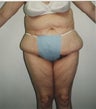 Abdominoplasty