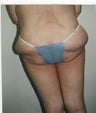 Abdominoplasty