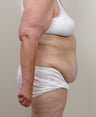 Panniculectomy