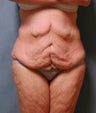 Lower Body Lift
