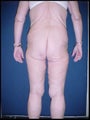Body Lift after Massive Weight Loss