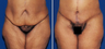 Lower Body Lift