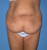 Torsoplasty