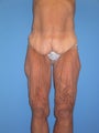 Torsoplasty
