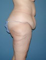 Body Lift