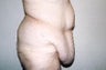 Body Contouring