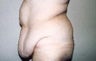 Body Contouring