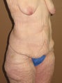 Belt lipectomy after weight loss