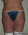 Bodylift
