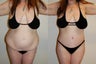 Body Lift