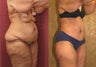 Body Lift after massive weight loss
