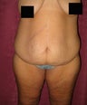 Body Lift after massive weight loss in los Angeles
