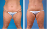 Central body lift with liposuction age 32