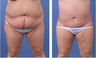 Central body lift with liposuction of thighs and back, age 42