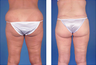 Central body lift with liposuction age 38