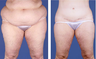 Central body lift with liposuction age 53