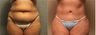 Lower Body Lift (Belt Lipectomy)