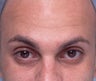 Cosmetic Microdroplet BOTOX® Treatment